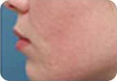 Acne scars, after treatment, as shown in the product brochure