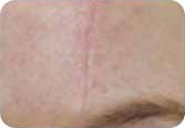 Scars, before treatment, as shown in the product brochure